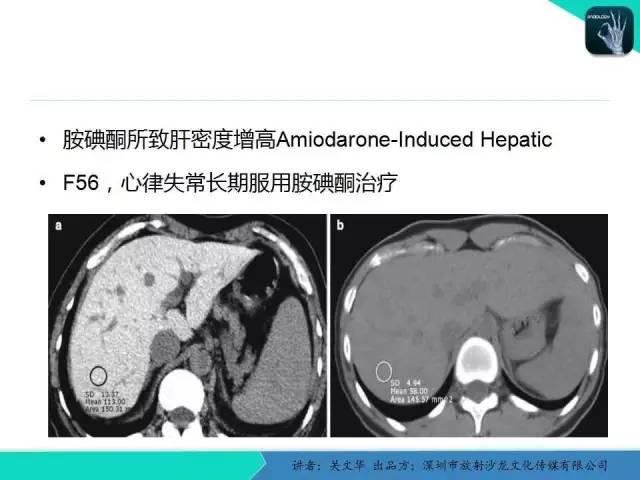 【PPT】精简版肝脏疾病的CT诊断