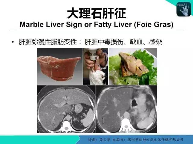 【PPT】精简版肝脏疾病的CT诊断