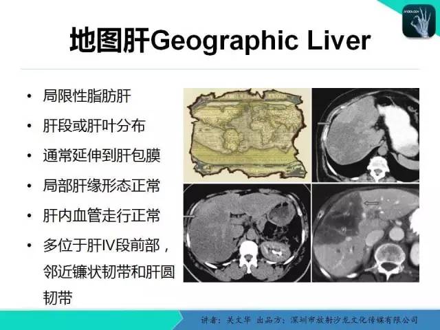 【PPT】精简版肝脏疾病的CT诊断