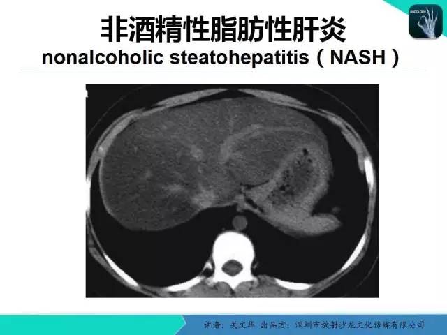 【PPT】精简版肝脏疾病的CT诊断