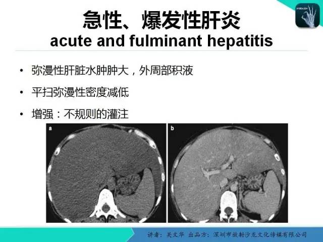 【PPT】精简版肝脏疾病的CT诊断