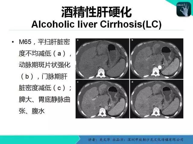 【PPT】精简版肝脏疾病的CT诊断