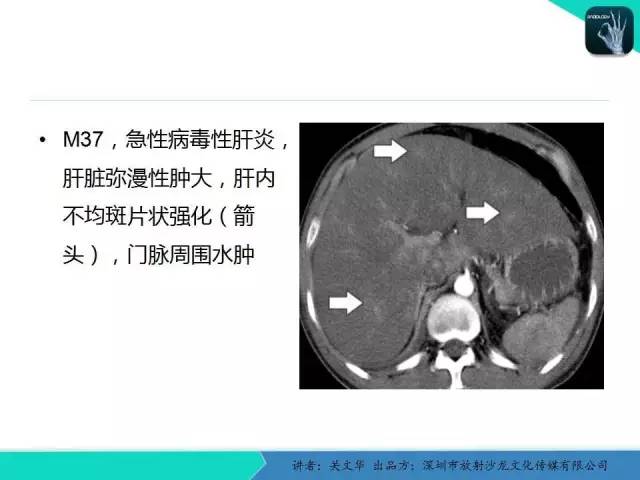【PPT】精简版肝脏疾病的CT诊断