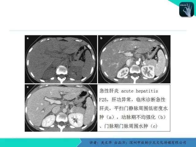 【PPT】精简版肝脏疾病的CT诊断