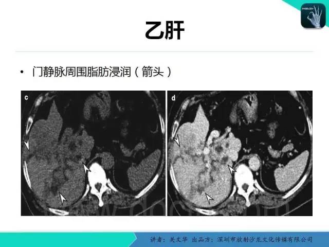 【PPT】精简版肝脏疾病的CT诊断
