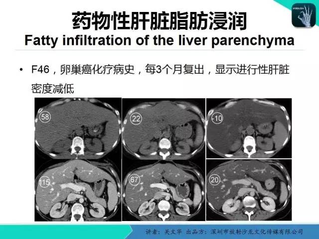 【PPT】精简版肝脏疾病的CT诊断
