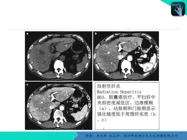 【PPT】精简版肝脏疾病的CT诊断