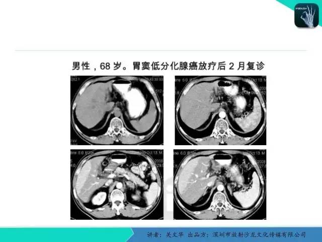 【PPT】精简版肝脏疾病的CT诊断