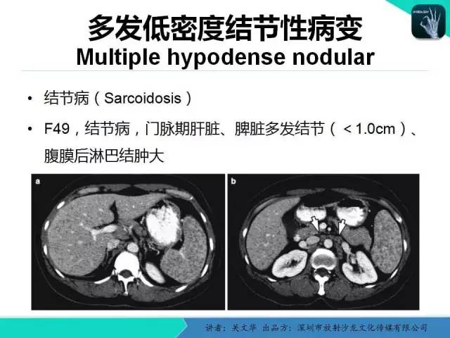 【PPT】精简版肝脏疾病的CT诊断