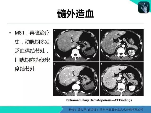 【PPT】精简版肝脏疾病的CT诊断