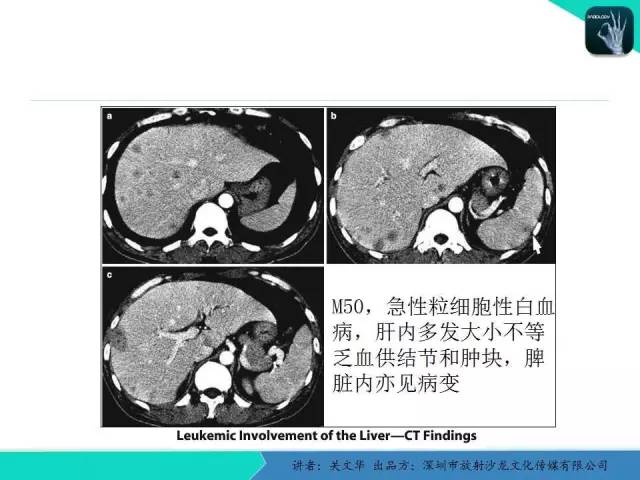 【PPT】精简版肝脏疾病的CT诊断