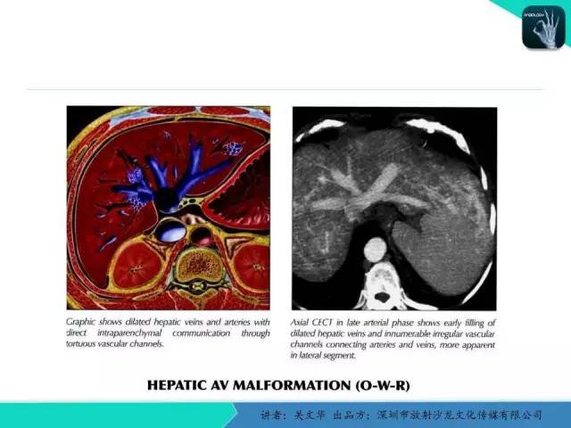 【PPT】精简版肝脏疾病的CT诊断