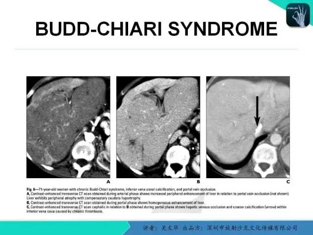 【PPT】精简版肝脏疾病的CT诊断