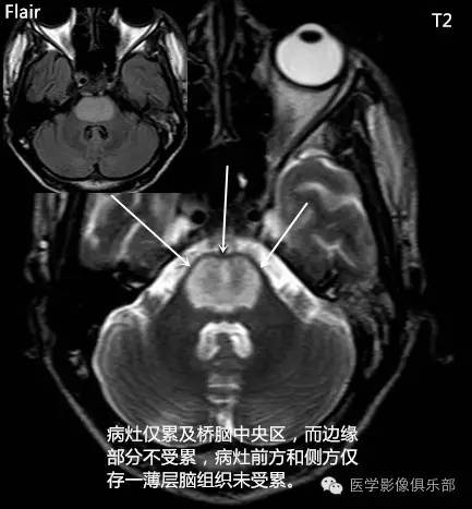 桥脑中央髓鞘溶解症 桥脑中央髓鞘溶解症