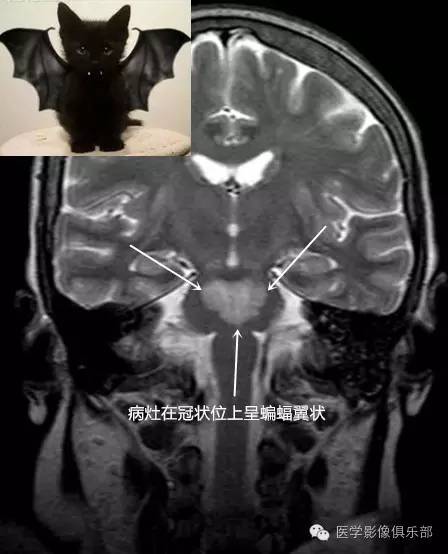 桥脑中央髓鞘溶解症 桥脑中央髓鞘溶解症