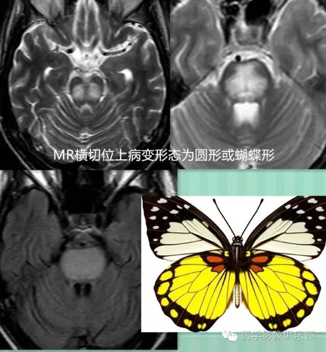 桥脑中央髓鞘溶解症 桥脑中央髓鞘溶解症