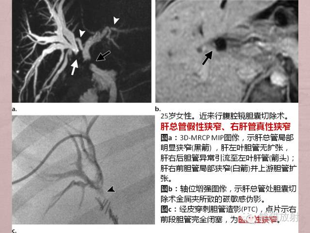 成人胆管狭窄的MRI及MRCP表现
