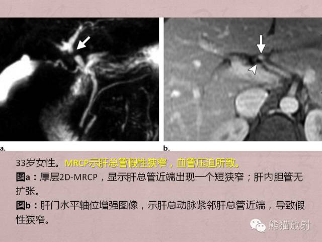 成人胆管狭窄的MRI及MRCP表现