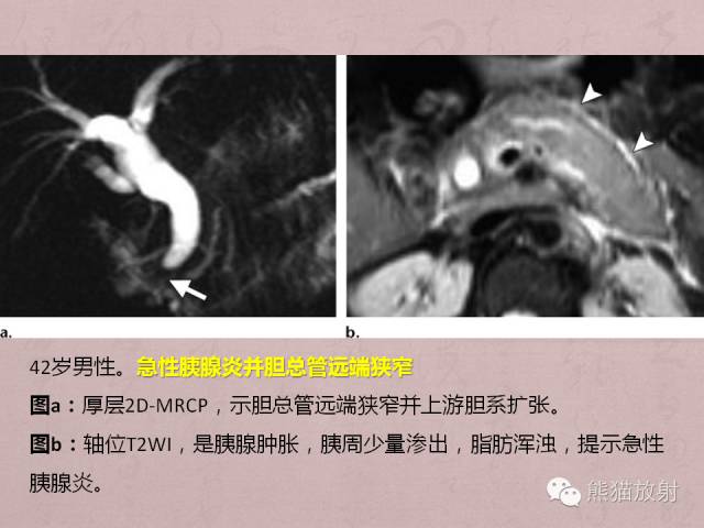 成人胆管狭窄的MRI及MRCP表现