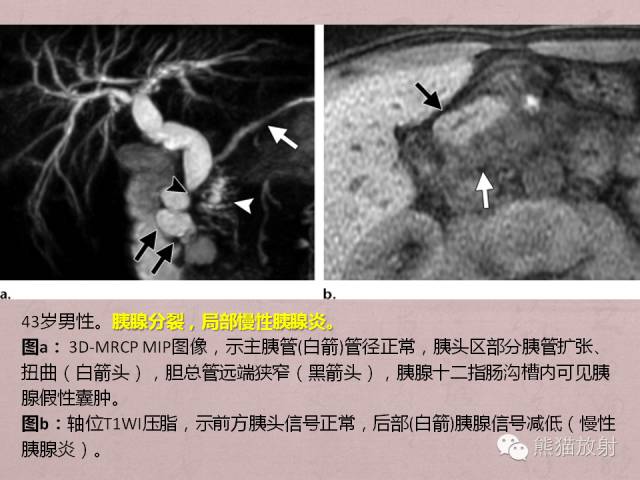 成人胆管狭窄的MRI及MRCP表现