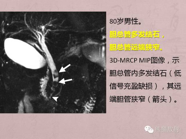 成人胆管狭窄的MRI及MRCP表现