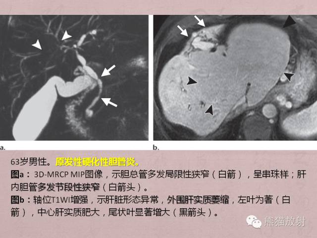 成人胆管狭窄的MRI及MRCP表现