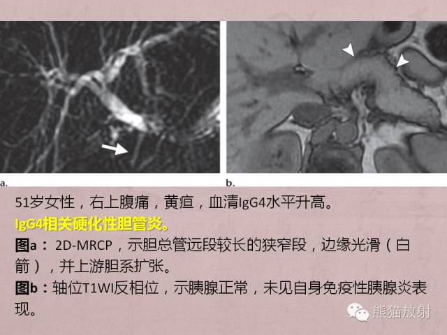 成人胆管狭窄的MRI及MRCP表现