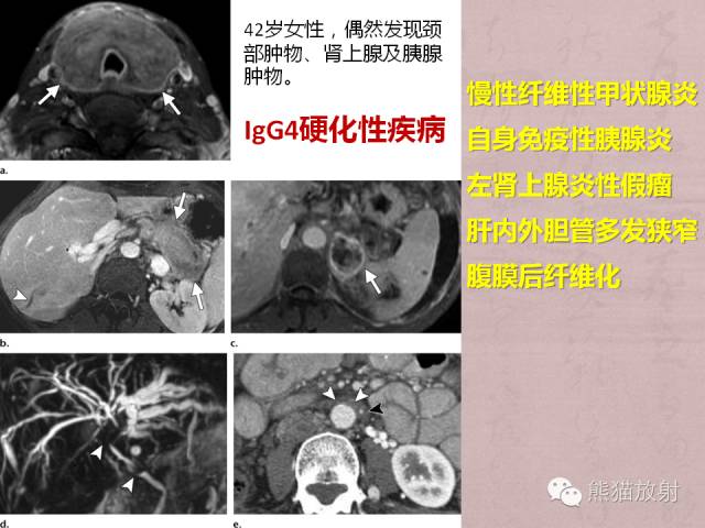 成人胆管狭窄的MRI及MRCP表现