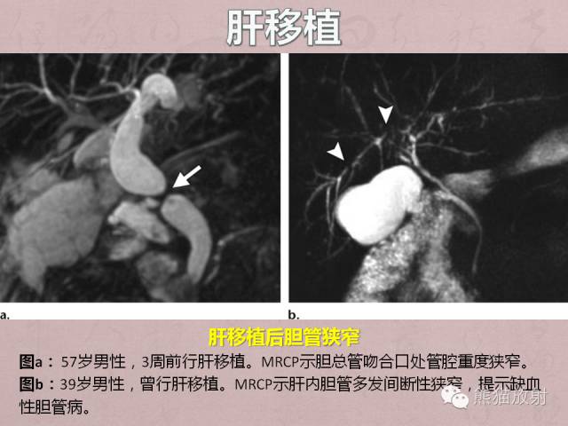 成人胆管狭窄的MRI及MRCP表现