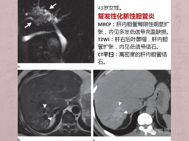 成人胆管狭窄的MRI及MRCP表现