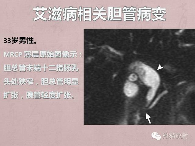 成人胆管狭窄的MRI及MRCP表现