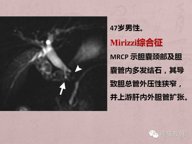 成人胆管狭窄的MRI及MRCP表现