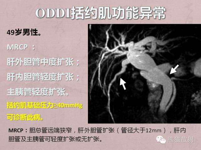 成人胆管狭窄的MRI及MRCP表现