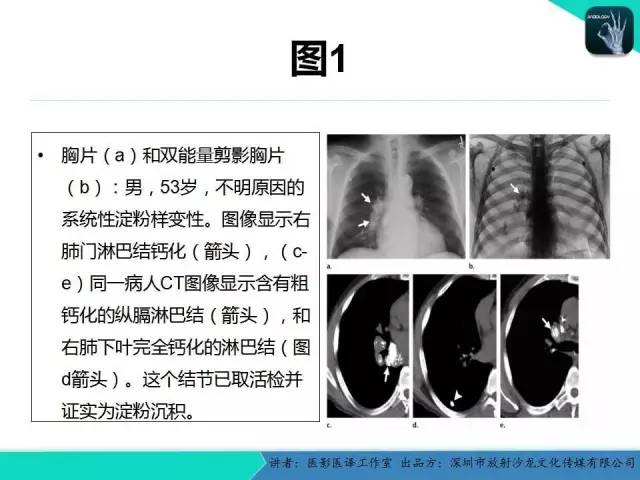 【PPT】淀粉样变性：现代断层成像