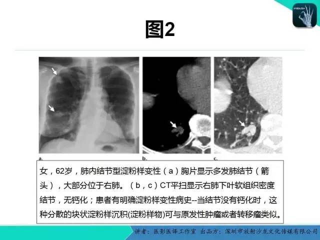 【PPT】淀粉样变性：现代断层成像