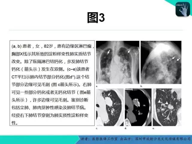 【PPT】淀粉样变性：现代断层成像