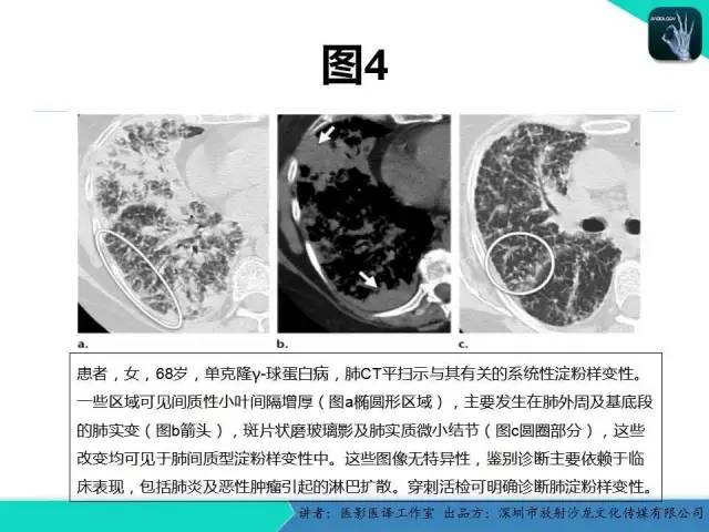 【PPT】淀粉样变性：现代断层成像
