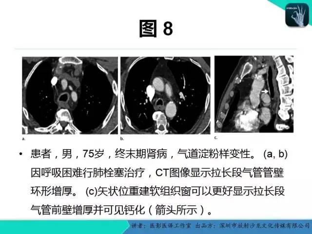 【PPT】淀粉样变性：现代断层成像