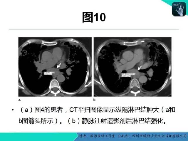 【PPT】淀粉样变性：现代断层成像