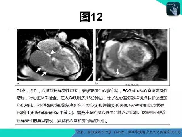 【PPT】淀粉样变性：现代断层成像