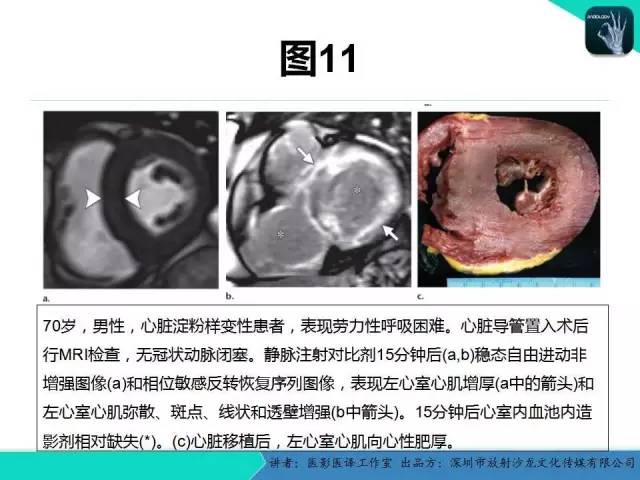 【PPT】淀粉样变性：现代断层成像