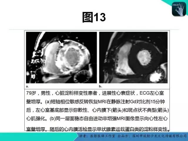 【PPT】淀粉样变性：现代断层成像