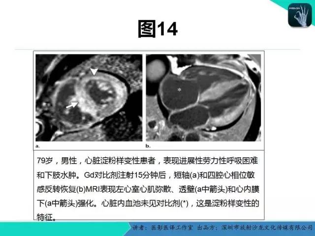 【PPT】淀粉样变性：现代断层成像