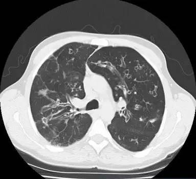 【病例】肺囊性纤维化1例CT影像表现 【病例】肺囊性纤维化1例CT影像表现