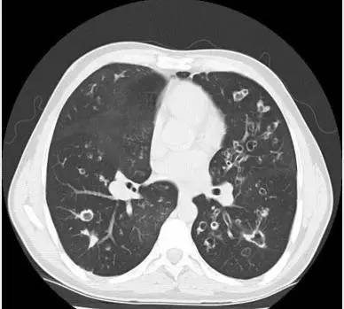 【病例】肺囊性纤维化1例CT影像表现 【病例】肺囊性纤维化1例CT影像表现