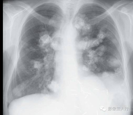 Carney三联征/肺软骨瘤