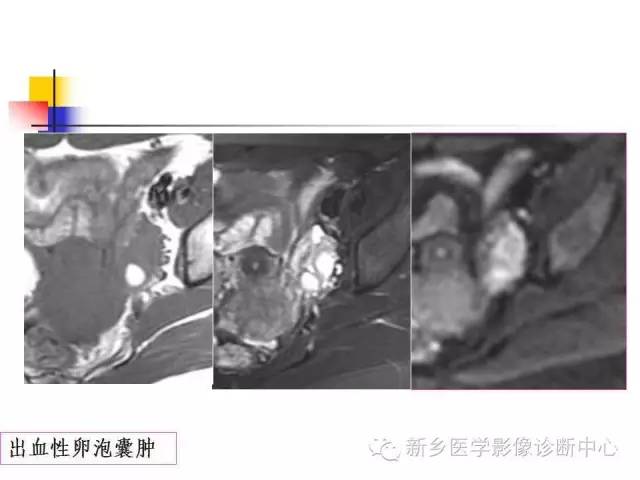 【PPT】卵巢的解剖和疾病诊断思路