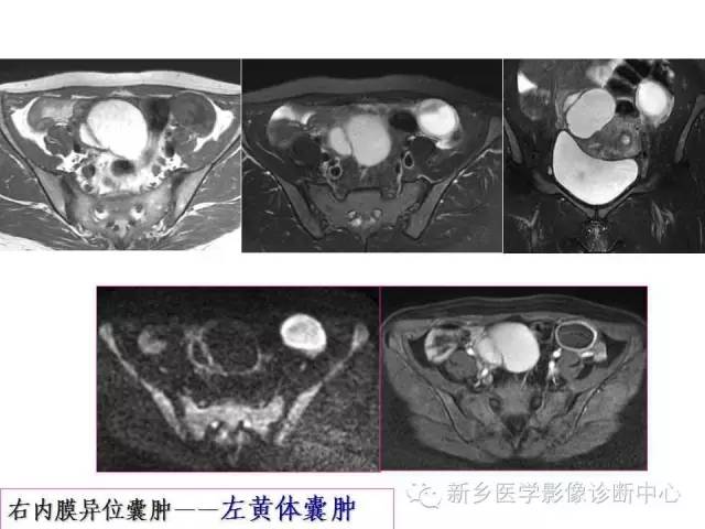 【PPT】卵巢的解剖和疾病诊断思路