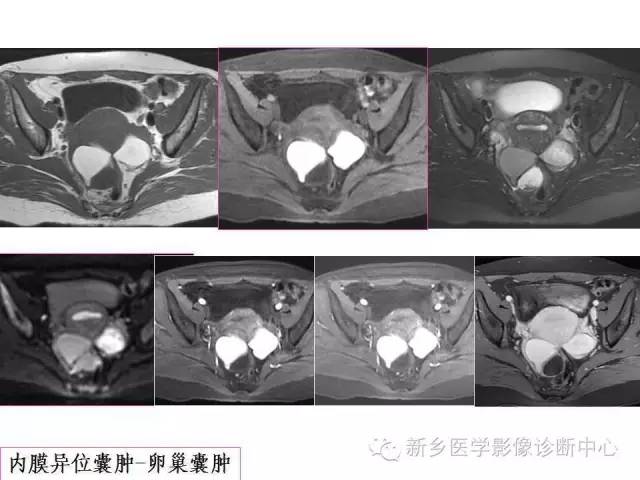 【PPT】卵巢的解剖和疾病诊断思路