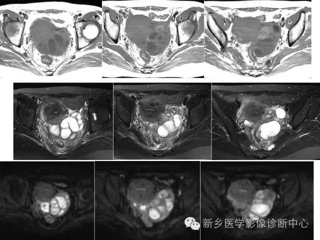 【PPT】卵巢的解剖和疾病诊断思路